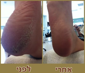 טיפול בעור יבש,כף הרגל עם עור קשה,טיפול בצפורן חודרנית,טיפול ביבלות פנימיות