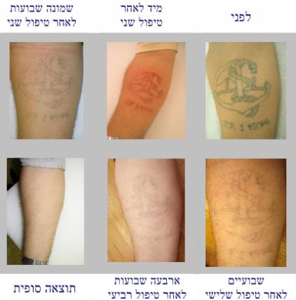 טופ לייזר תוצאות הטיפול בהסרת קעקוע בלייזר  